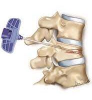 تزریق سیمان به مهره شکسته 2023